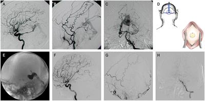 Adult dural arteriovenous fistulas in Galen region: More to be rediscovered